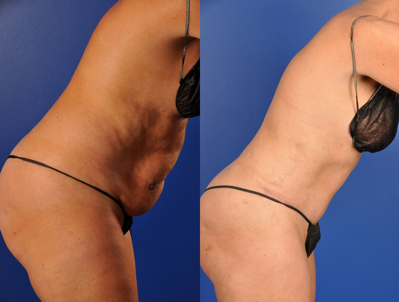 Before and After Image: Mommy Makeover - other