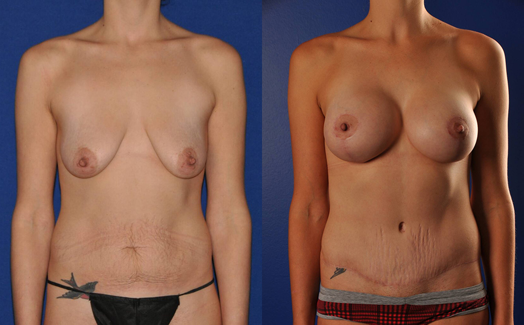 Before and After Image: Mommy Makeover - front