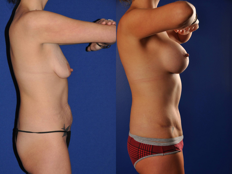 Before and After Image: Mommy Makeover - right-side