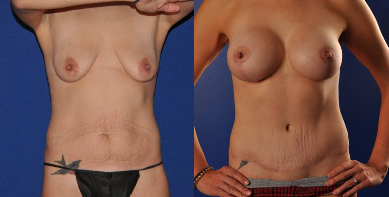 Before and After Image: Mommy Makeover - front