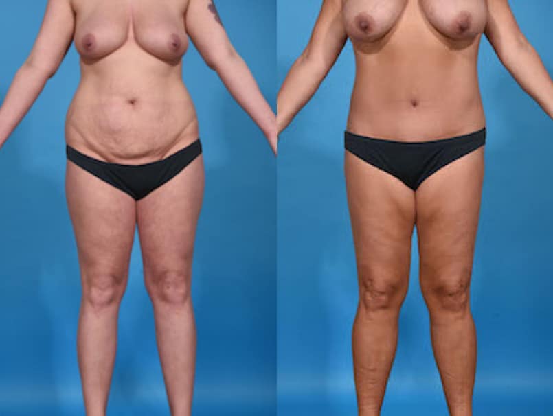 Before and After Image: Mommy Makeover - front