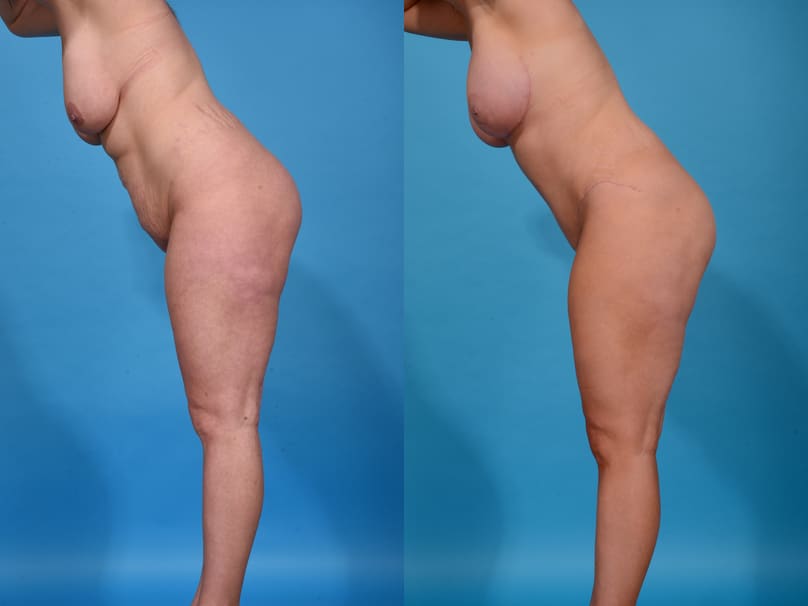 Before and After Image: Mommy Makeover - left-side