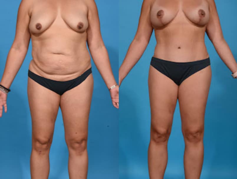 Before and After Image: Mommy Makeover - front