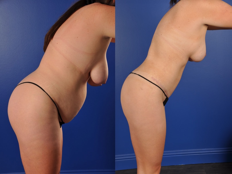 Before and After Image: Mommy Makeover - other