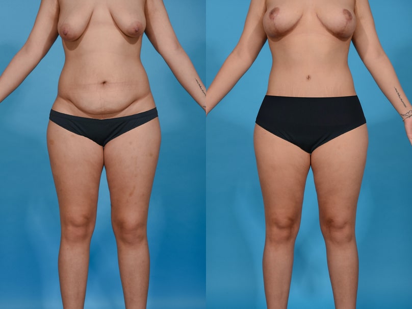 Before and After Image: Mommy Makeover - front