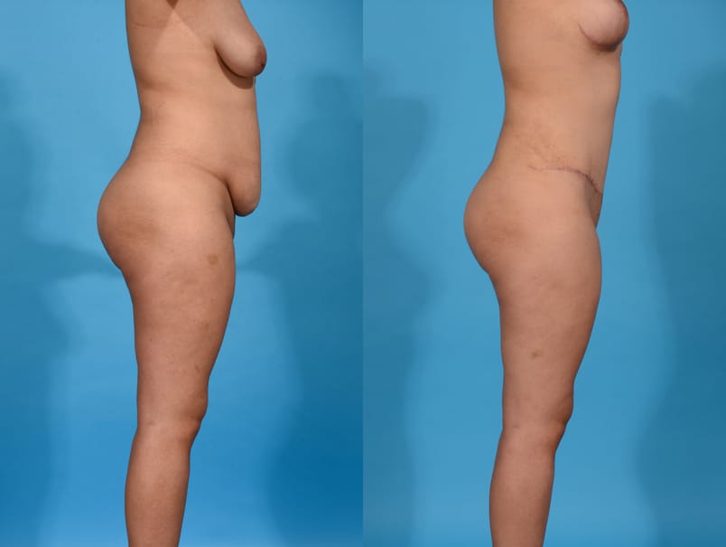 Before and After Image: Mommy Makeover - right-side