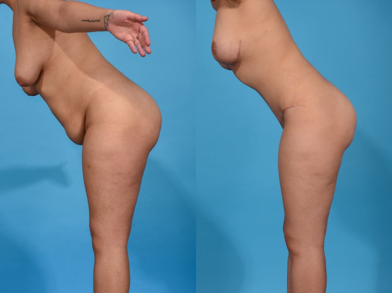 Before and After Image: Mommy Makeover - other