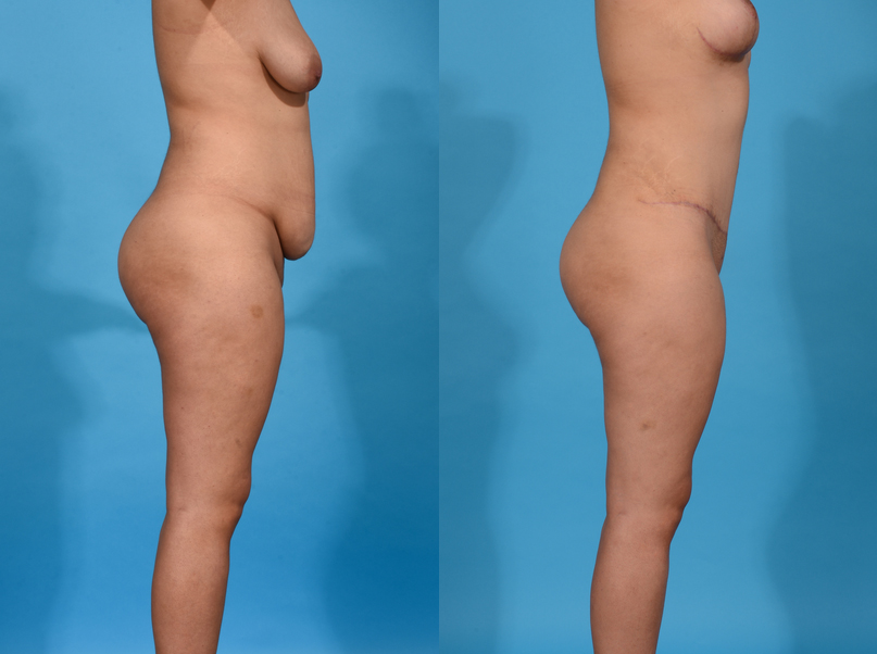 Before and After Image: Mommy Makeover - right-side