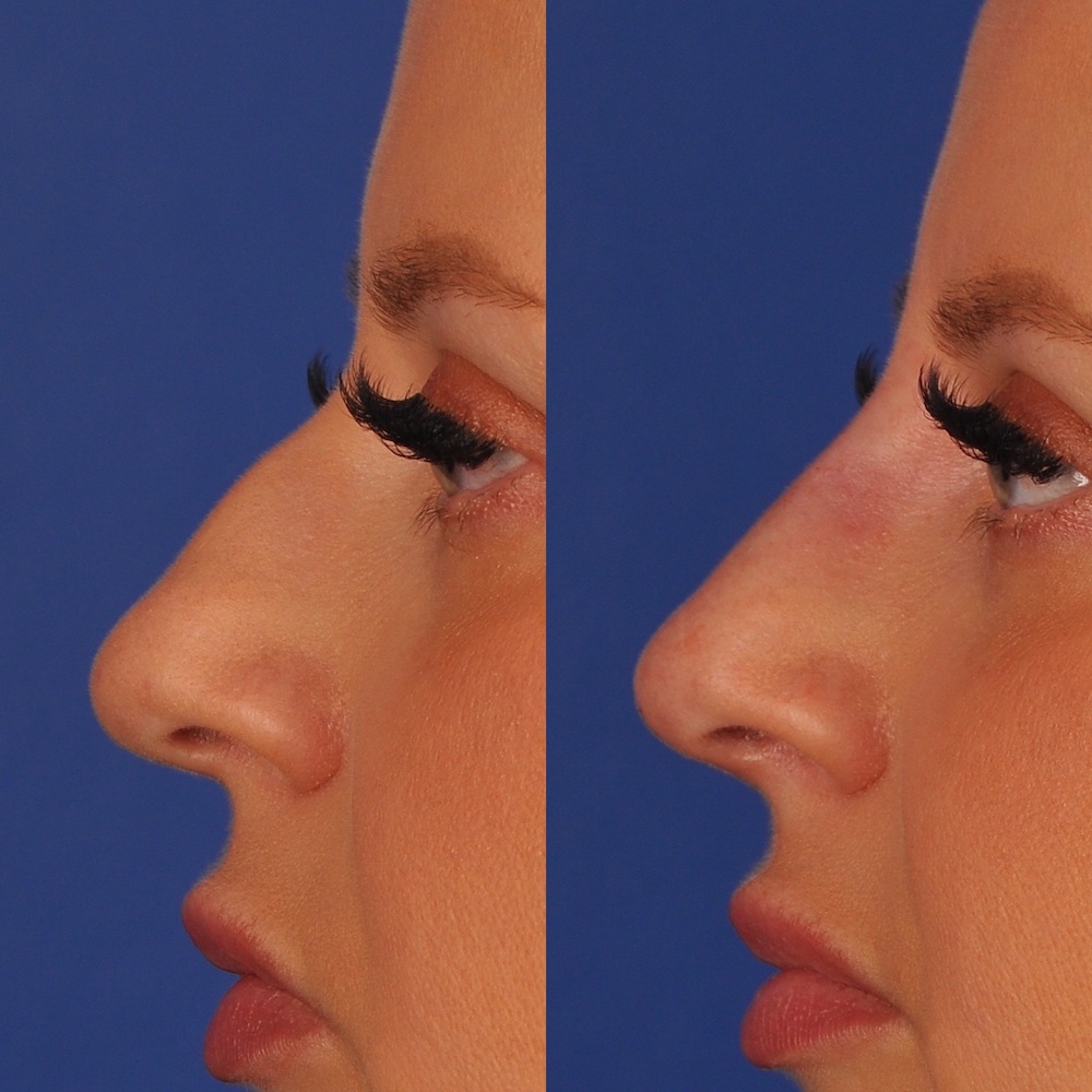 Before and After Image: Rhinoplasty - left-side