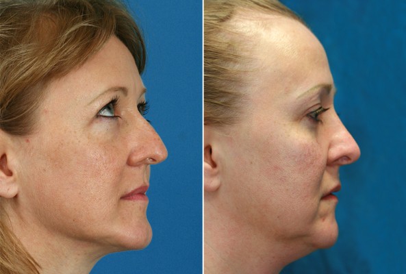 Before and After Image: Rhinoplasty - right-side