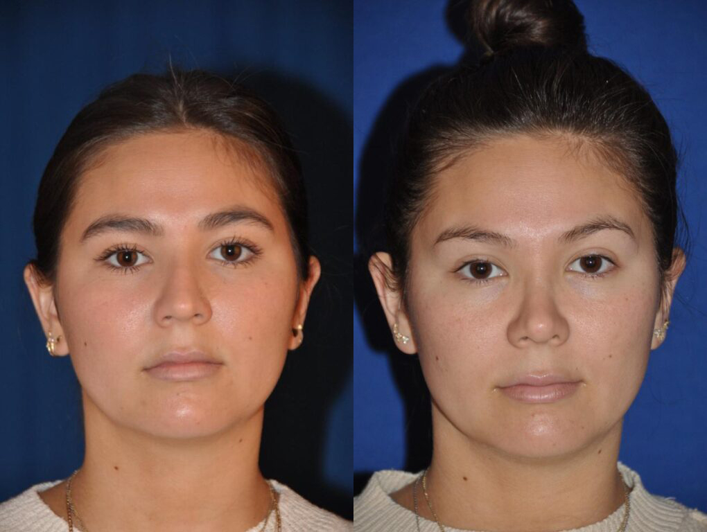 Before and After Image: Rhinoplasty Lateral - front