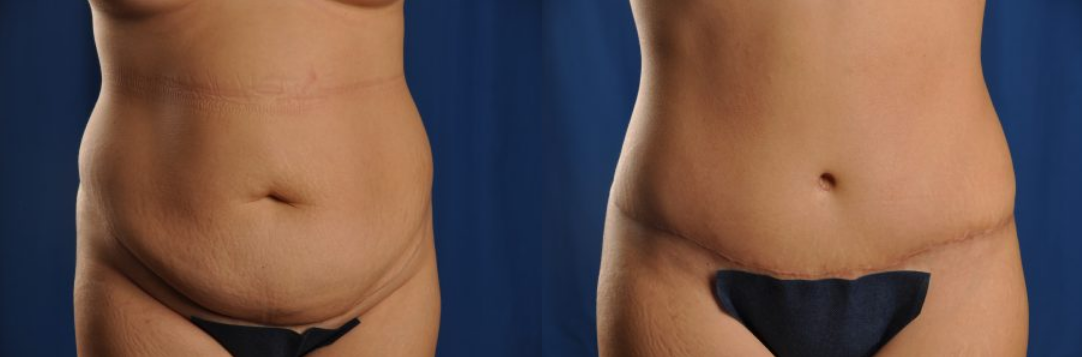 Before and After Image: Tummy Tuck - front