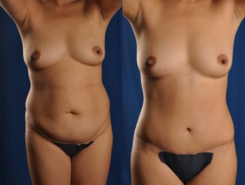 Before and After Image: Tummy Tuck - front