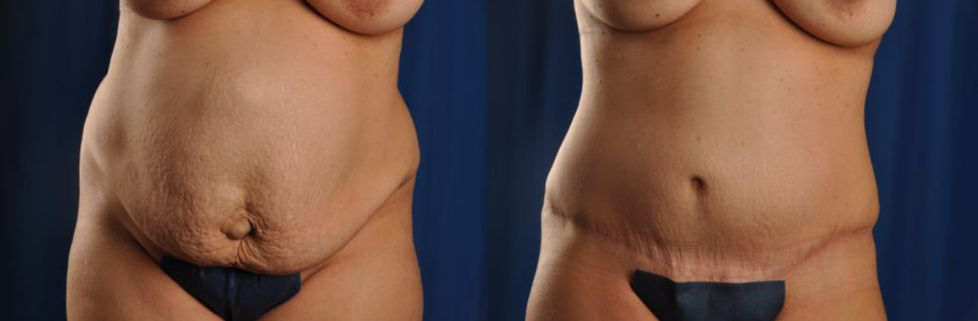 Before and After Image: Tummy Tuck - front
