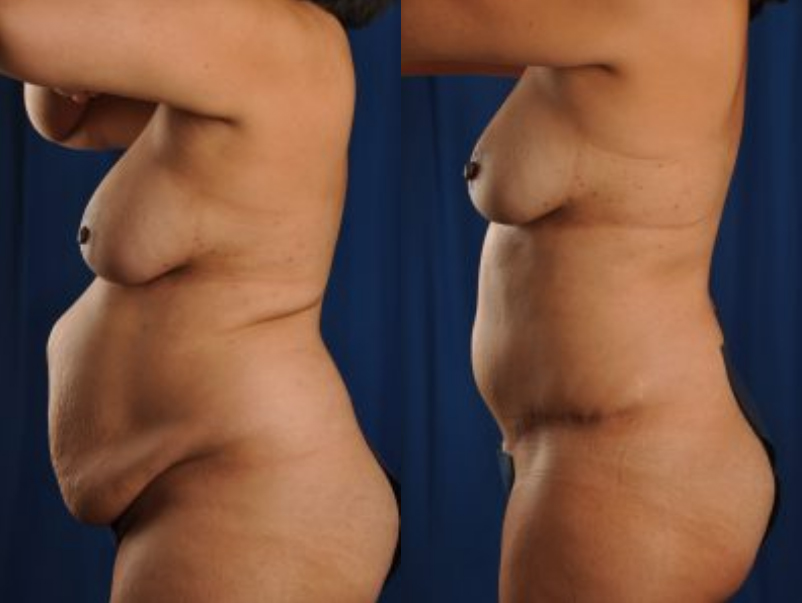Before and After Image: Tummy Tuck - left-side