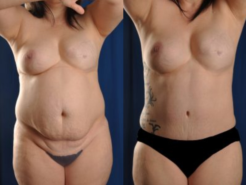 Before and After Image: Tummy Tuck - front