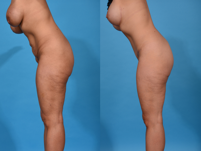 Before and After Image: Tummy Tuck - left-side