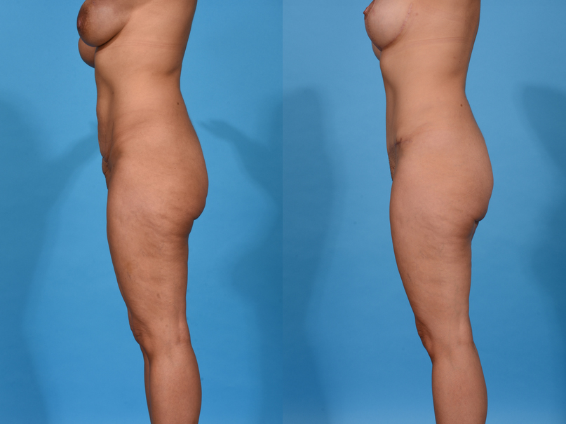 Before and After Image: Tummy Tuck - left-side