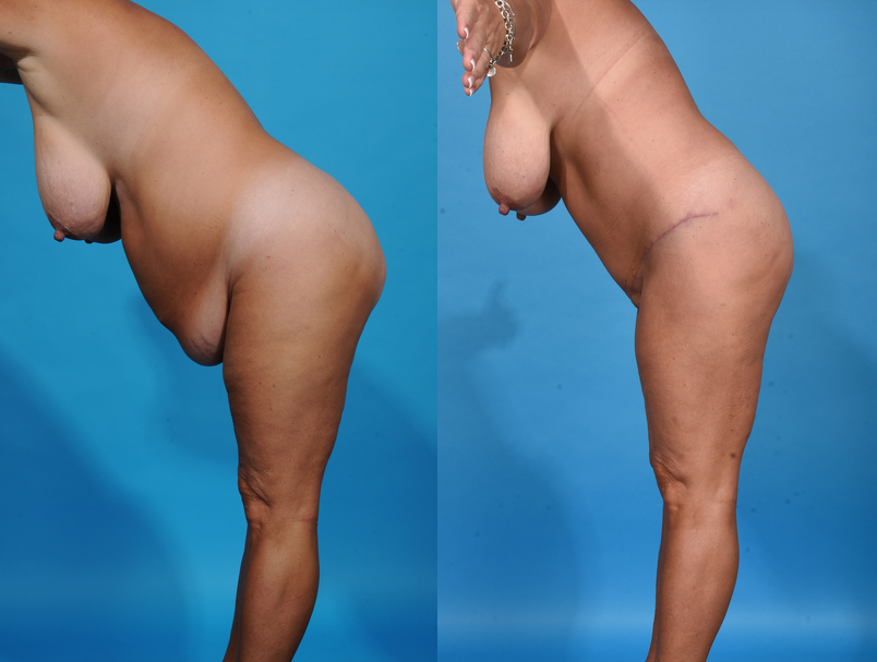 Before and After Image: Tummy Tuck - other