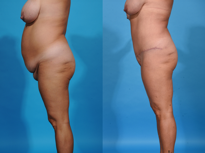 Before and After Image: Tummy Tuck - left-side