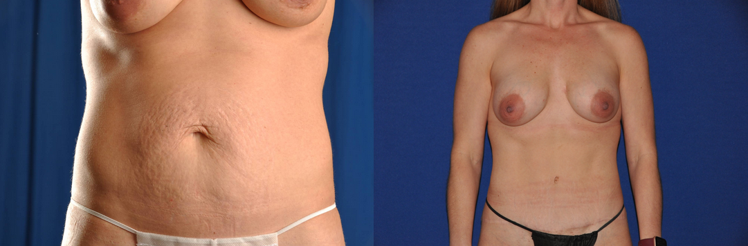 Before and After Image: Tummy Tuck - right-side