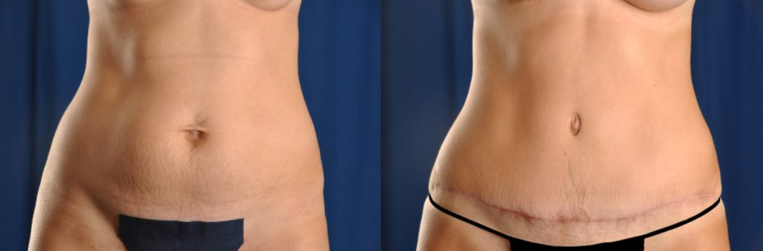 Before and After Image: Tummy Tuck - front