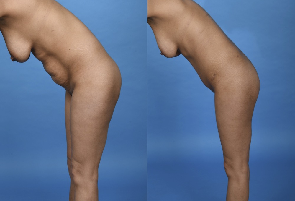 Before and After Image: Tummy Tuck - left-side