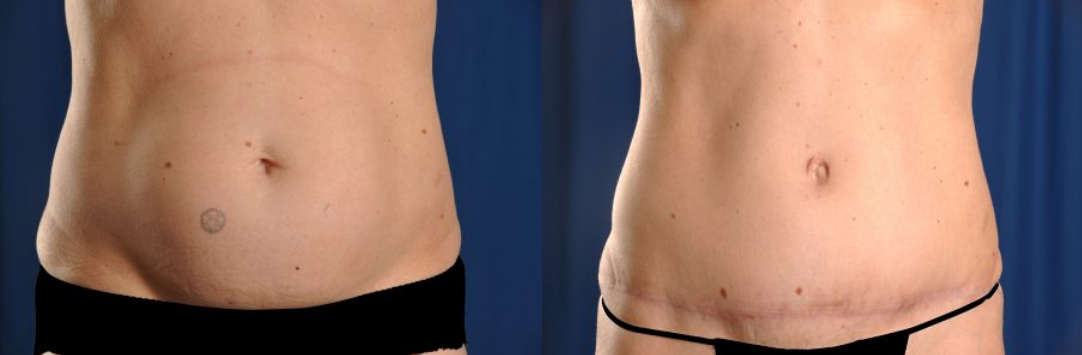 Before and After Image: Tummy Tuck - front