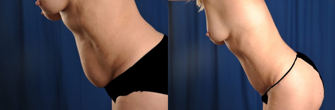 Before and After Image: Tummy Tuck - other