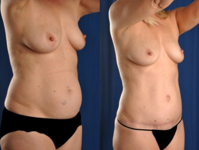Before and After Image: Tummy Tuck - right-front-oblique