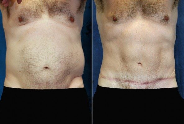 Before and After Image: Tummy Tuck - front
