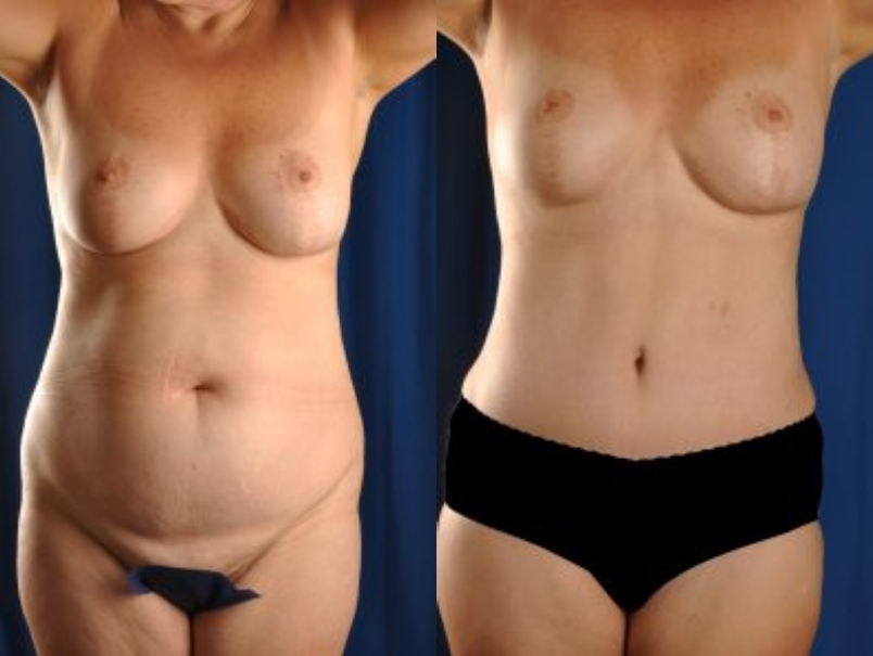 Before and After Image: Tummy Tuck - front
