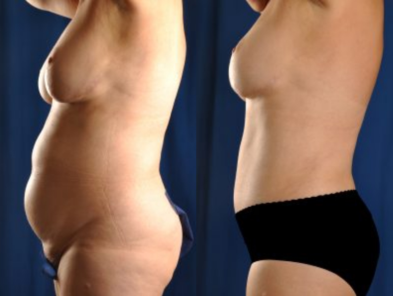 Before and After Image: Tummy Tuck - left-side