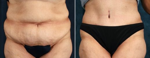Before and After Image: Tummy Tuck - front