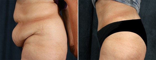 Before and After Image: Tummy Tuck - left-side