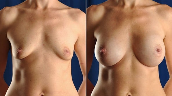 Before and After Image: Breast Augmentation - front