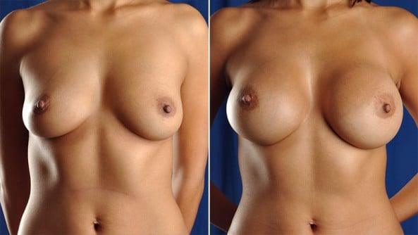Before and After Image: Breast Augmentation - front