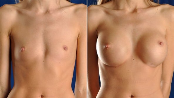 Before and After Image: Breast Augmentation - front