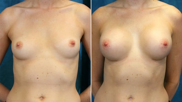 Before and After Image: Breast Augmentation - front