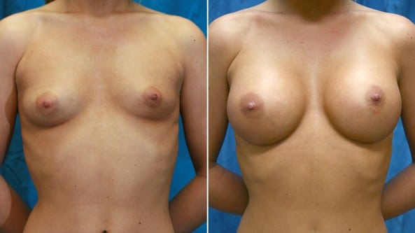 Before and After Image: Breast Augmentation - front
