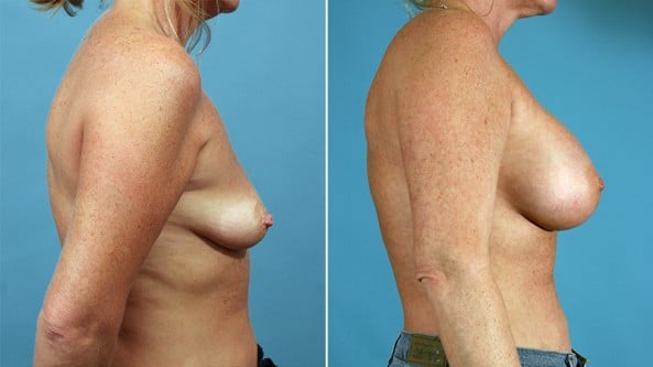 Before and After Image: Breast Augmentation - right-side