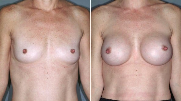 Before and After Image: Breast Augmentation - front