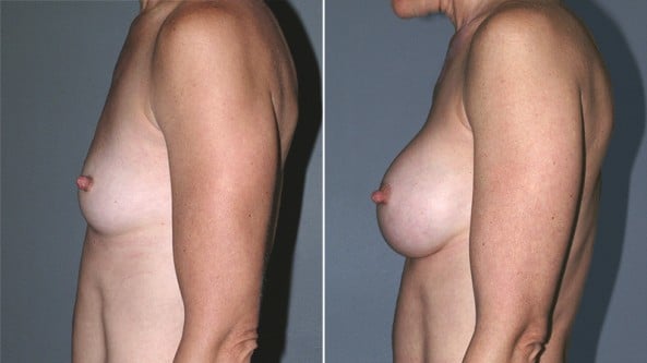 Before and After Image: Breast Augmentation - left-side