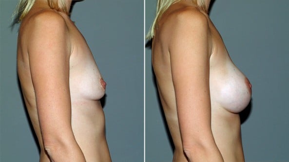 Before and After Image: Breast Augmentation - right-side