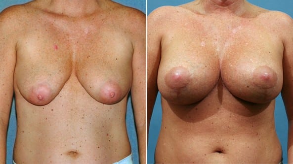 Before and After Image: Breast Augmentation - front