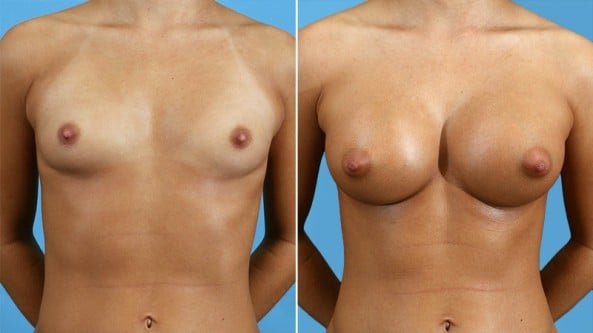 Before and After Image: Breast Augmentation - front
