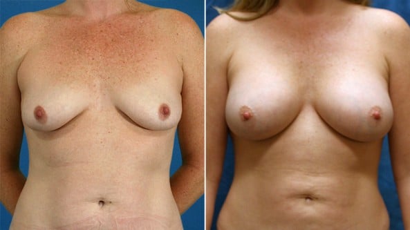 Before and After Image: Breast Augmentation - front