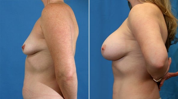 Before and After Image: Breast Augmentation - left-side