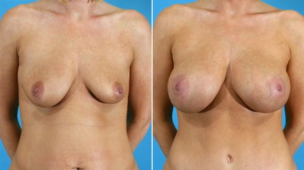 Before and After Image: Breast Augmentation - front
