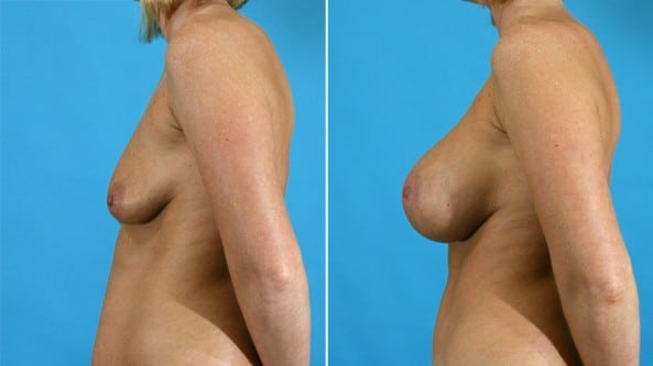 Before and After Image: Breast Augmentation - left-side